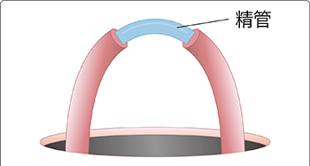 パイプカット手術②：精管を切断・結索
