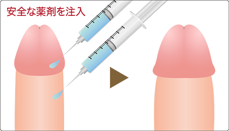 ペニス増大術