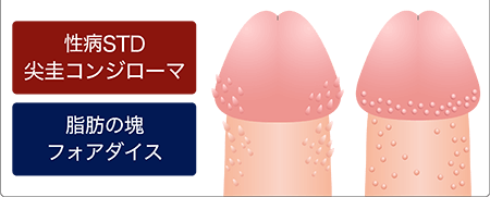 ペニスにできるブツブツの種類